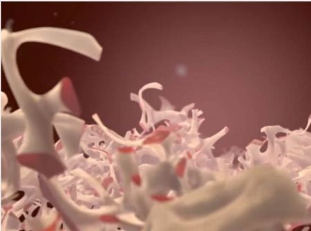 Osteoporosis Animation – Medical Animation